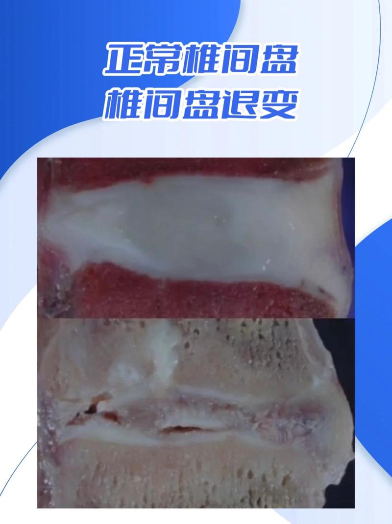 椎间盘退变精准治疗有了新策略