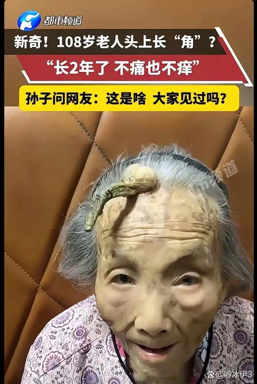 62岁阿姨头上长出“牛角”!医生:常见于这个群体,别忽视