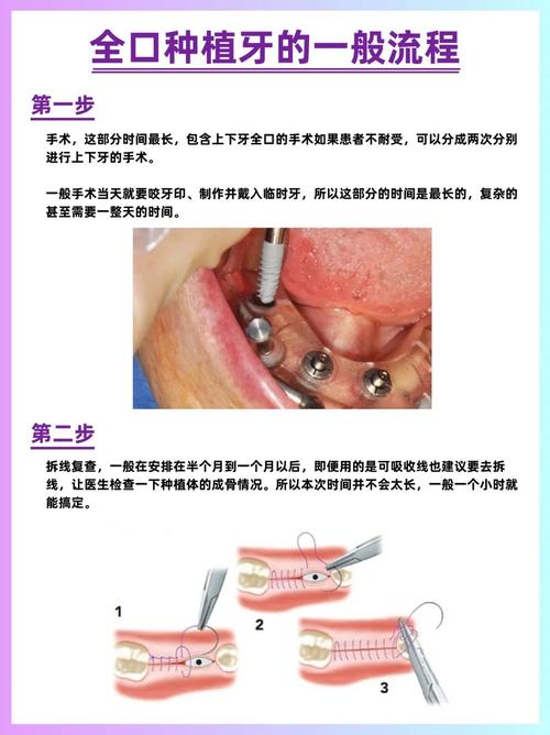 作为人类的“第三副牙齿”,种植牙到底有何优势?种植过程是怎么样的?