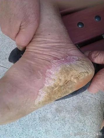 脚后跟总干裂的人,可能是感染了这种“真菌”!
