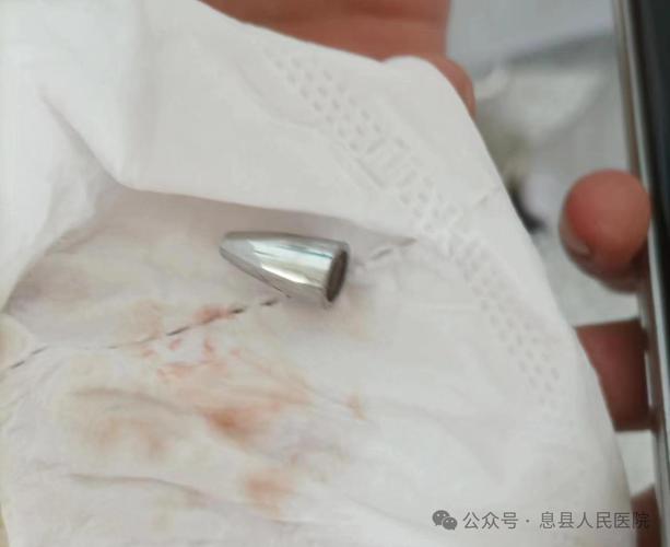 4岁幼童三年时间反复患上肺炎七八次!医生从肺里取出异物后,大吃一惊……