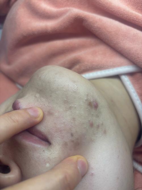 那些经常挤痘痘的人,后来都怎么样了?_1