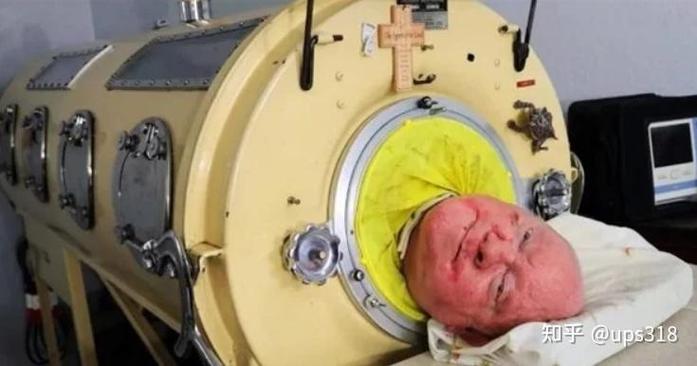 活在罐子里70多年,世上最后一名铁肺人去世