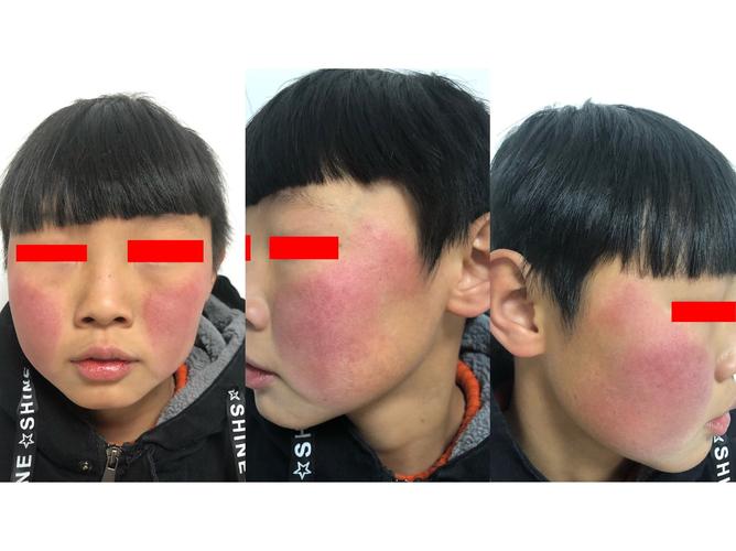 杭州10岁男孩出现弥漫性红斑!家长懊悔:太大意了……